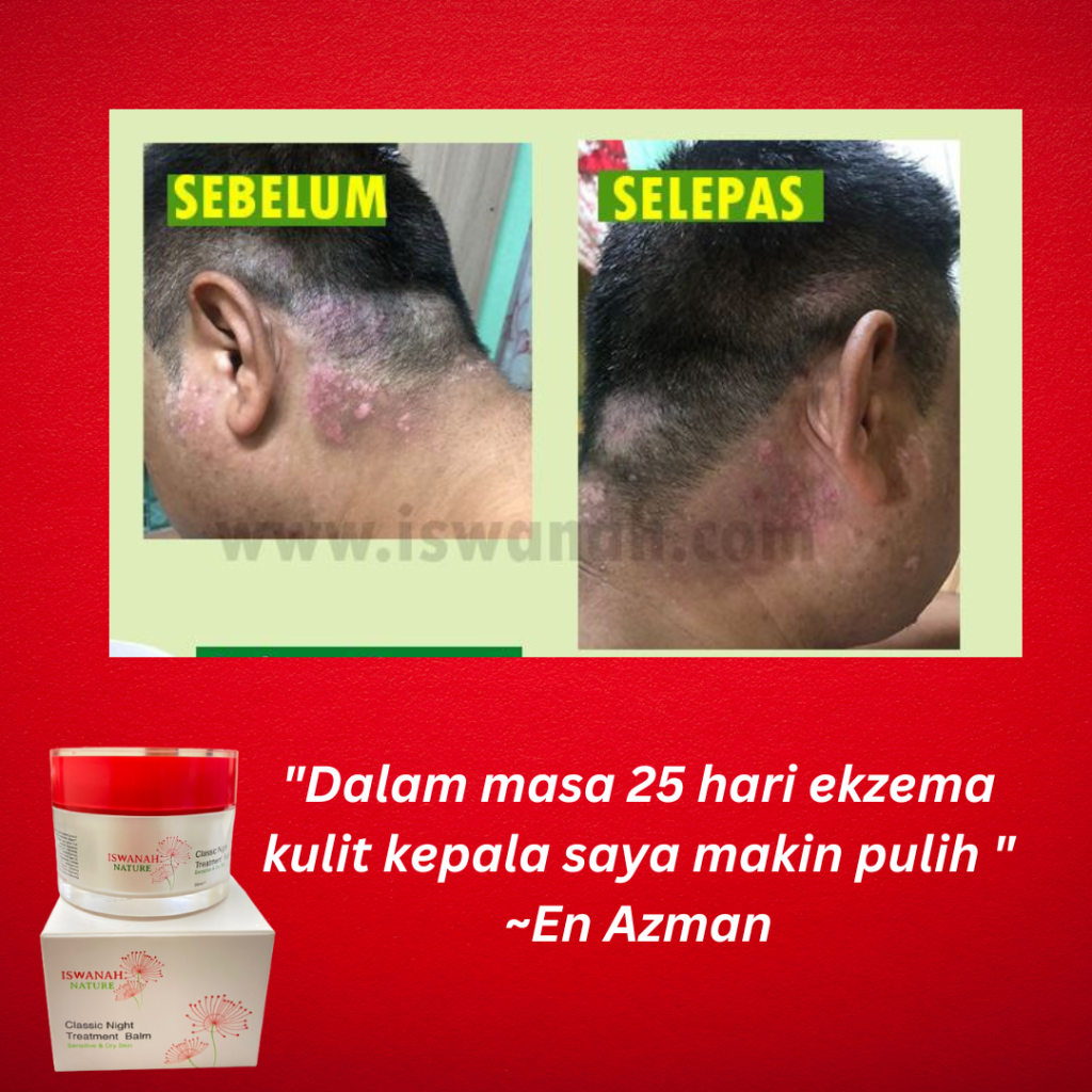 krim psoriasis terbaik
