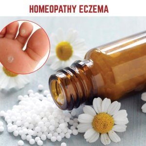 homeopathy eczema