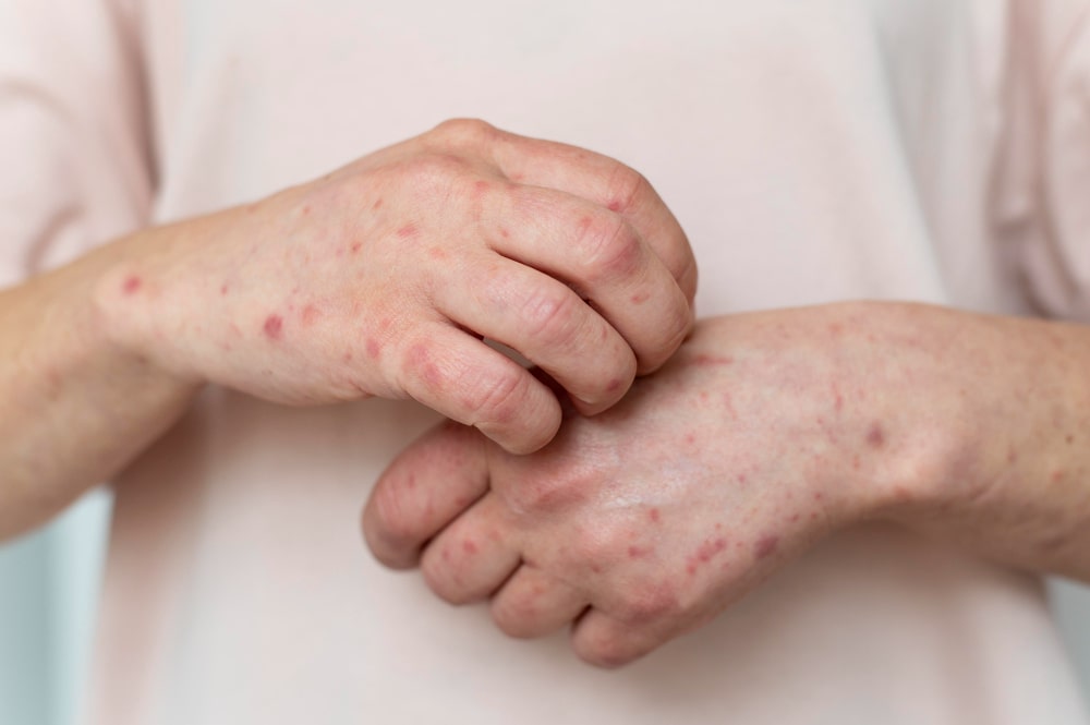 eczema